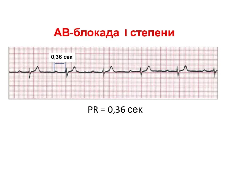 АВ-блокада I степени PR = 0,36 сек 0,36 сек