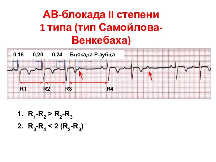 АВ-блокада II степени 1 типа (тип Самойлова-Венкебаха) 0,18 0,20 0,24 Блокада P-зубца