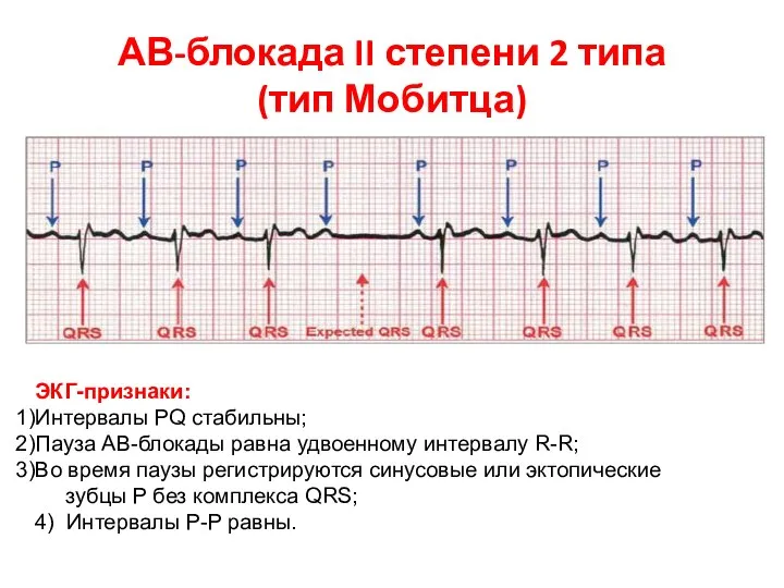 АВ-блокада II степени 2 типа (тип Мобитца) ЭКГ-признаки: Интервалы PQ стабильны; Пауза