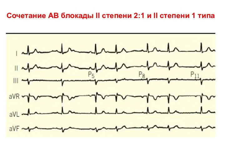 Сочетание АВ блокады II степени 2:1 и II степени 1 типа