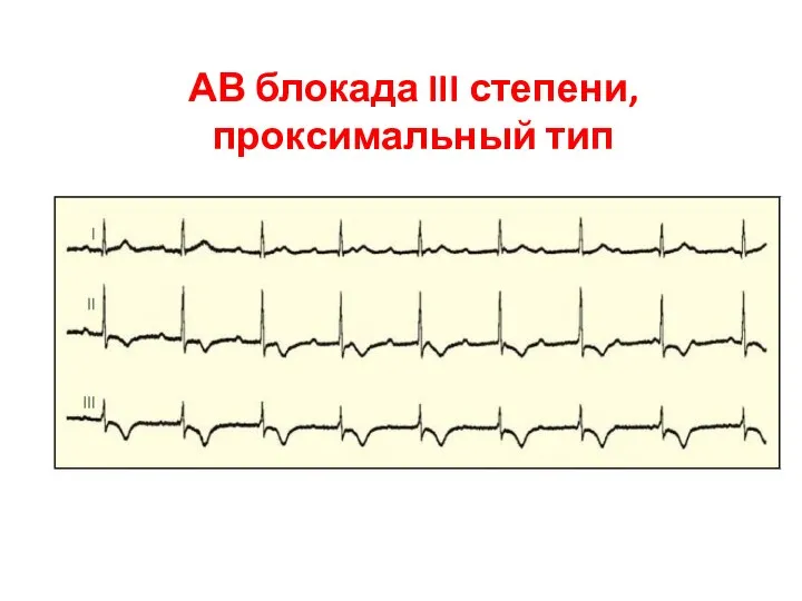 АВ блокада III степени, проксимальный тип