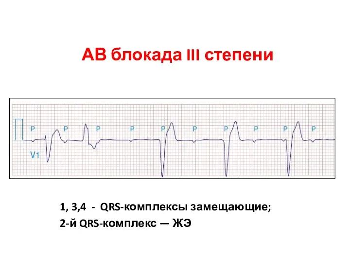 АВ блокада III степени 1, 3,4 - QRS-комплексы замещающие; 2-й QRS-комплекс — ЖЭ