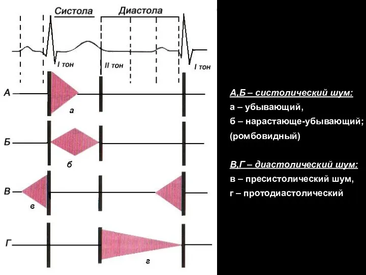 А,Б – систолический шум: а – убывающий, б – нарастающе-убывающий; (ромбовидный) В,Г