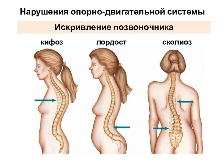 Нарушения опорно-двигательной системы сколиоз лордост кифоз Искривление позвоночника