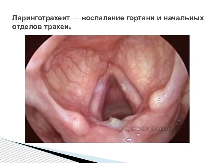 Ларинготрахеит — воспаление гортани и начальных отделов трахеи.