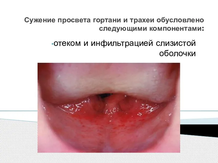 Сужение просвета гортани и трахеи обусловлено следующими компонентами: отеком и инфильтрацией слизистой оболочки