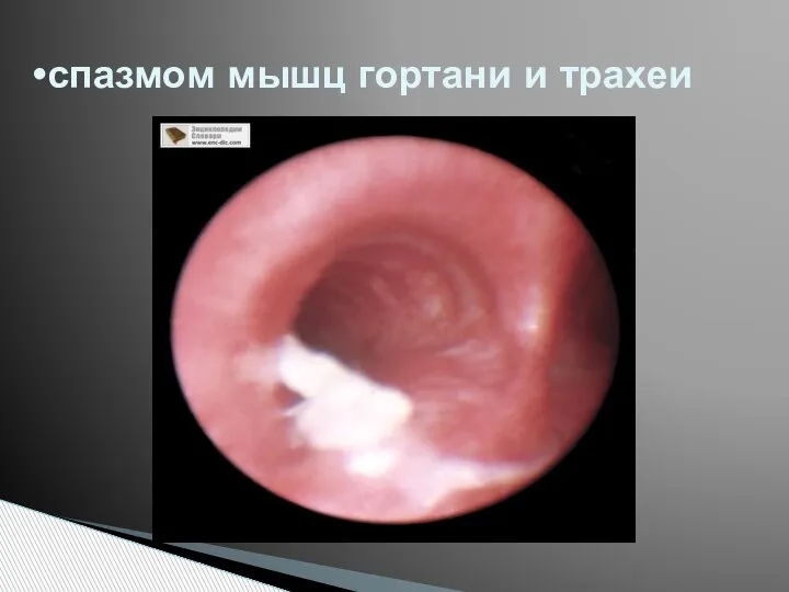 спазмом мышц гортани и трахеи