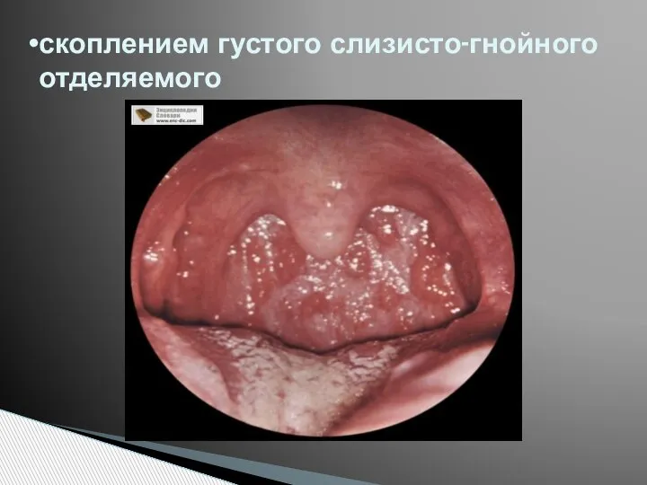 скоплением густого слизисто-гнойного отделяемого