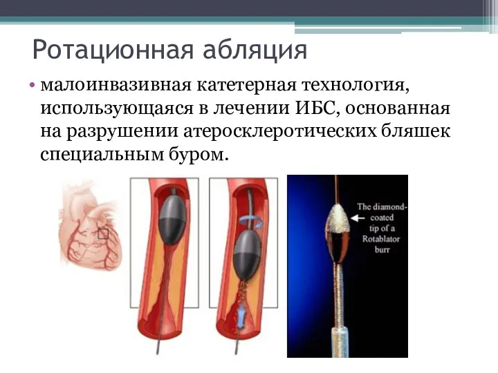 Ротационная абляция малоинвазивная катетерная технология, использующаяся в лечении ИБС, основанная на разрушении атеросклеротических бляшек специальным буром.