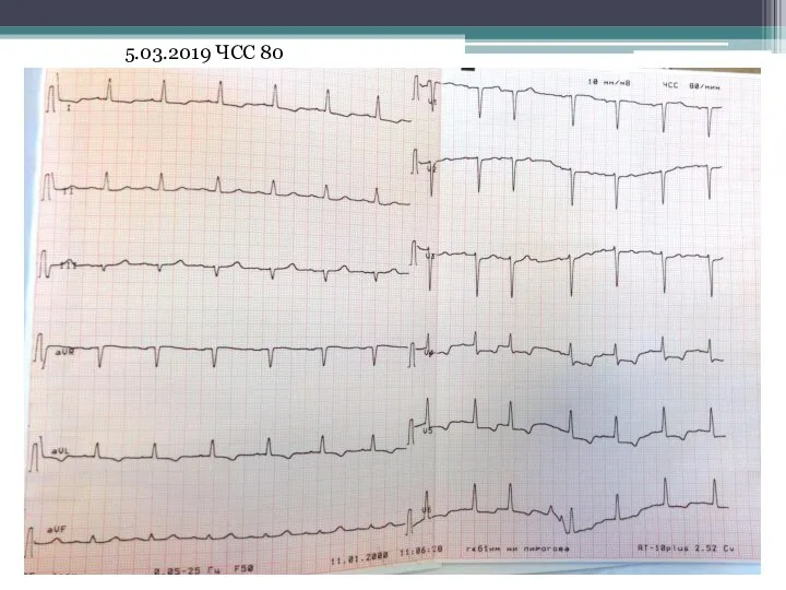 5.03.2019 ЧСС 80