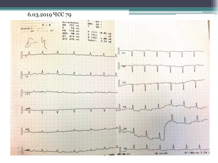 6.03.2019 ЧСС 79