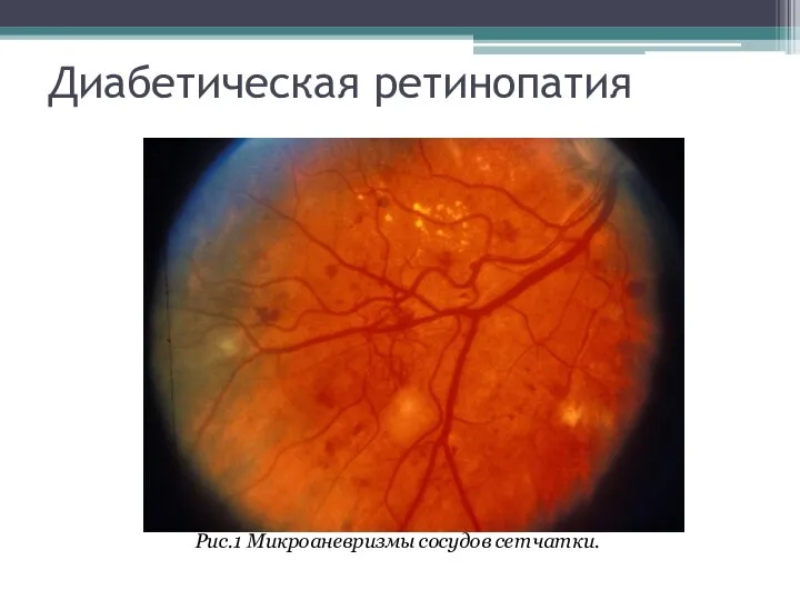 Диабетическая ретинопатия Рис.1 Микроаневризмы сосудов сетчатки.