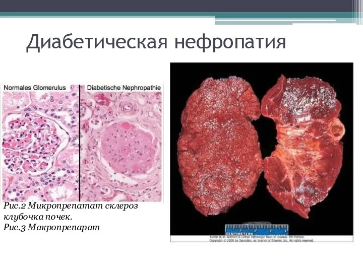 Диабетическая нефропатия Рис.2 Микропрепатат склероз клубочка почек. Рис.3 Макропрепарат