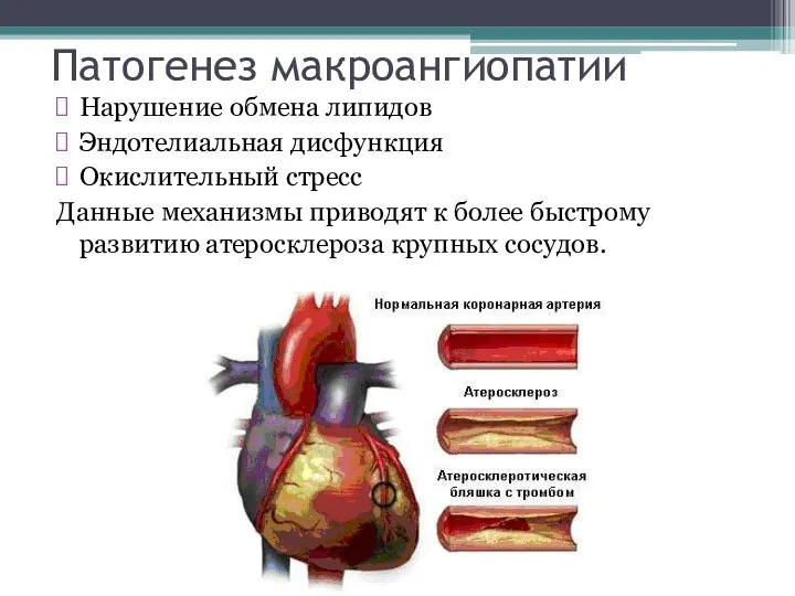 Патогенез макроангиопатии Нарушение обмена липидов Эндотелиальная дисфункция Окислительный стресс Данные механизмы приводят