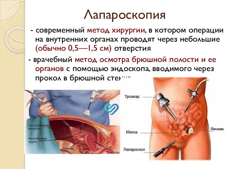 Лапароскопия - современный метод хирургии, в котором операции на внутренних органах проводят