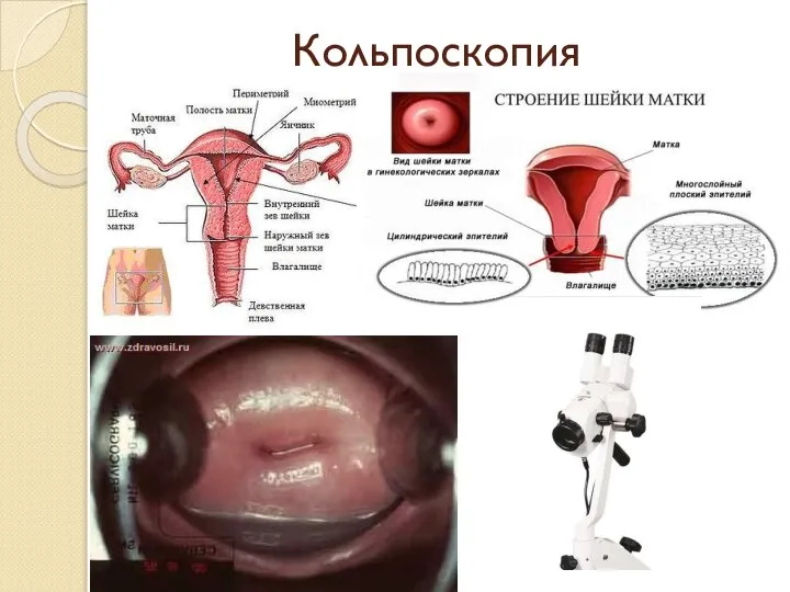 Кольпоскопия