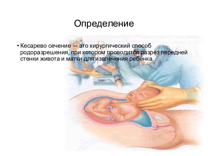 Определение Кесарево сечение — это хирургический способ родоразрешения, при котором проводится разрез