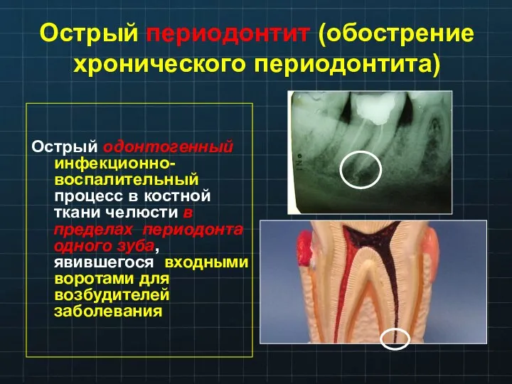 Острый периодонтит (обострение хронического периодонтита) Острый одонтогенный инфекционно-воспалительный процесс в костной ткани