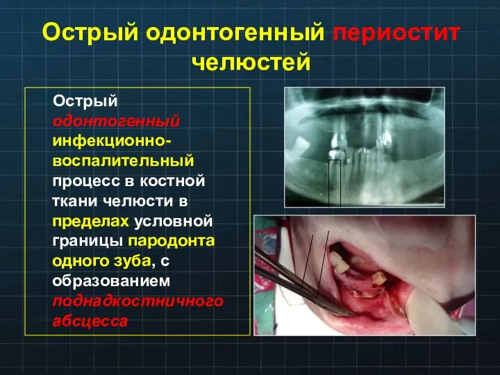 Острый одонтогенный периостит челюстей Острый одонтогенный инфекционно-воспалительный процесс в костной ткани челюсти