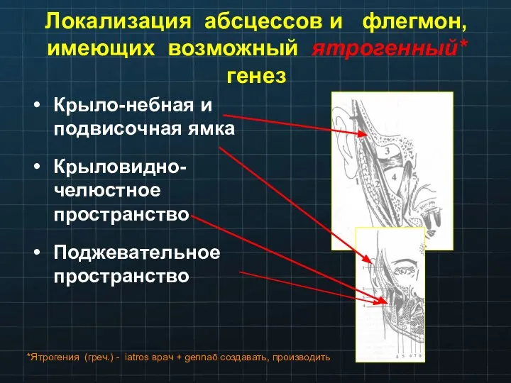 Локализация абсцессов и флегмон, имеющих возможный ятрогенный* генез Крыло-небная и подвисочная ямка