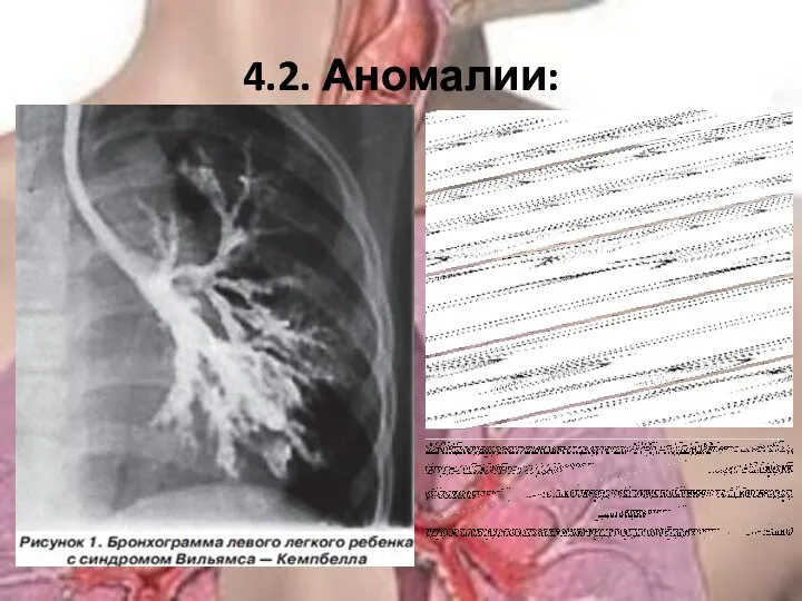 4.2. Аномалии: