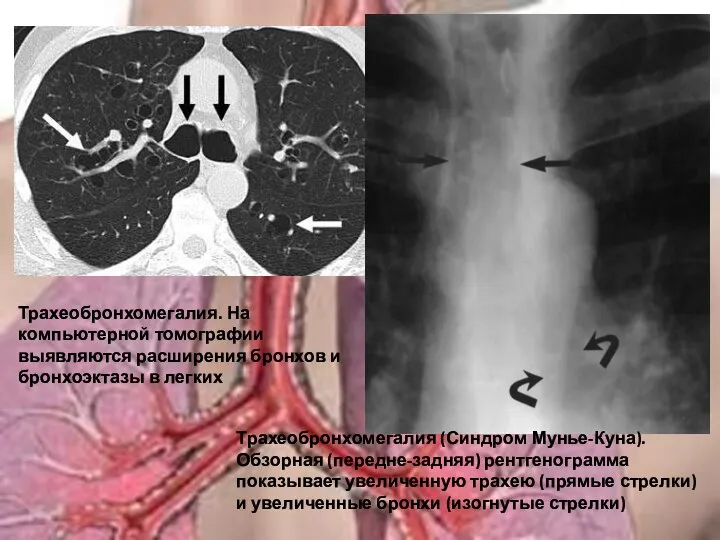 Трахеобронхомегалия (Синдром Мунье-Куна). Обзорная (передне-задняя) рентгенограмма показывает увеличенную трахею (прямые стрелки) и