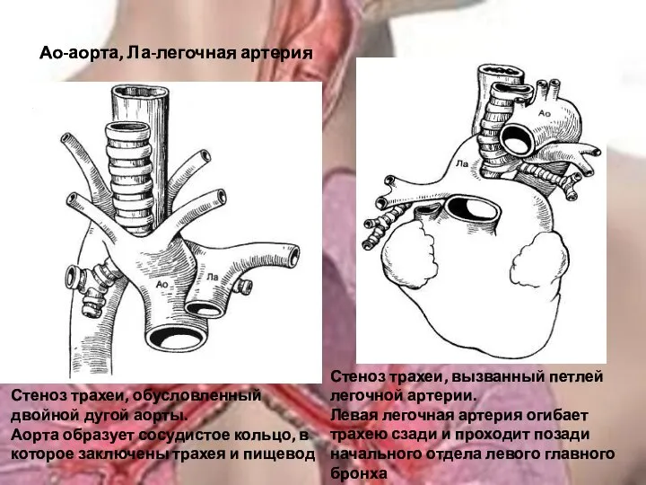 Стеноз трахеи, обусловленный двойной дугой аорты. Аорта образует сосудистое кольцо, в которое