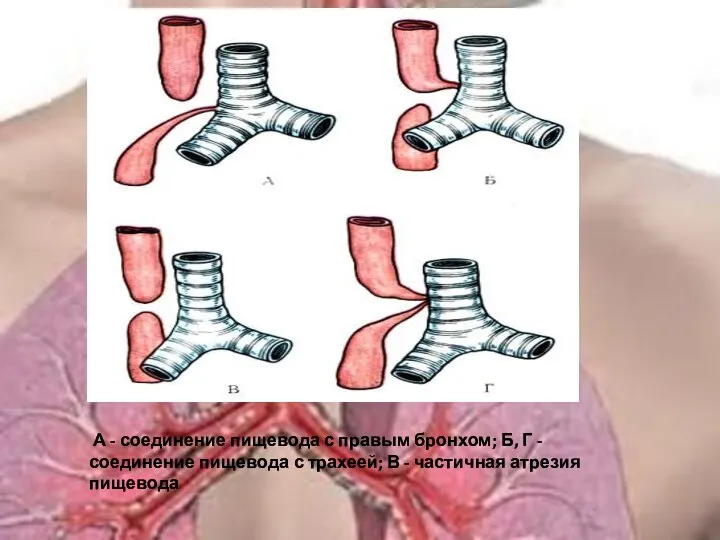 А - соединение пищевода с правым бронхом; Б, Г - соединение пищевода