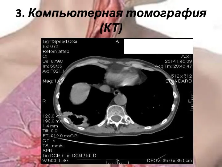 3. Компьютерная томография (КТ)