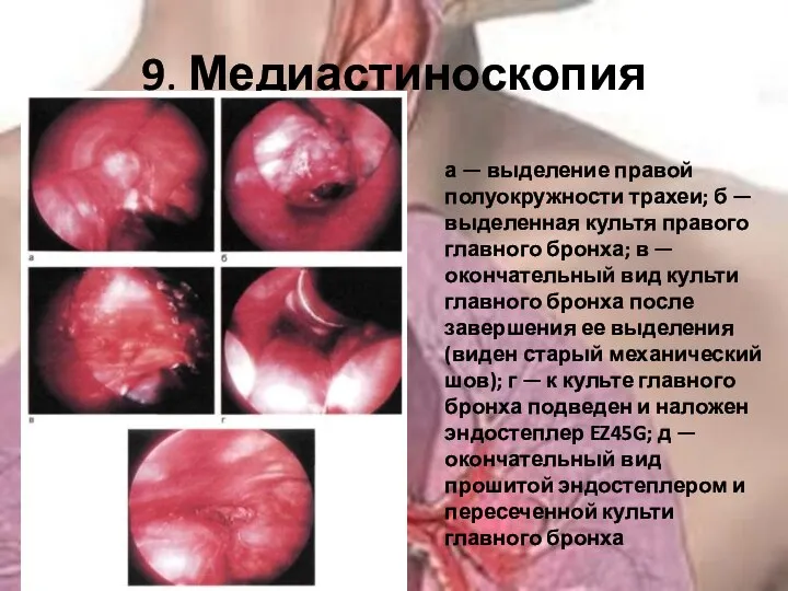 9. Медиастиноскопия а — выделение правой полуокружности трахеи; б — выделенная культя