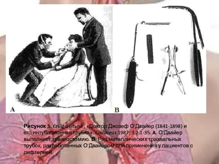 Рисунок 5. Craig Gelfand , «Доктор Джозеф О'Двайер (1841-1898) и его интубационная