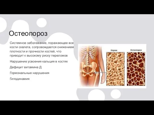 Остеопороз Системное заболевание, поражающее все кости скелета, сопровождается снижением плотности и прочности