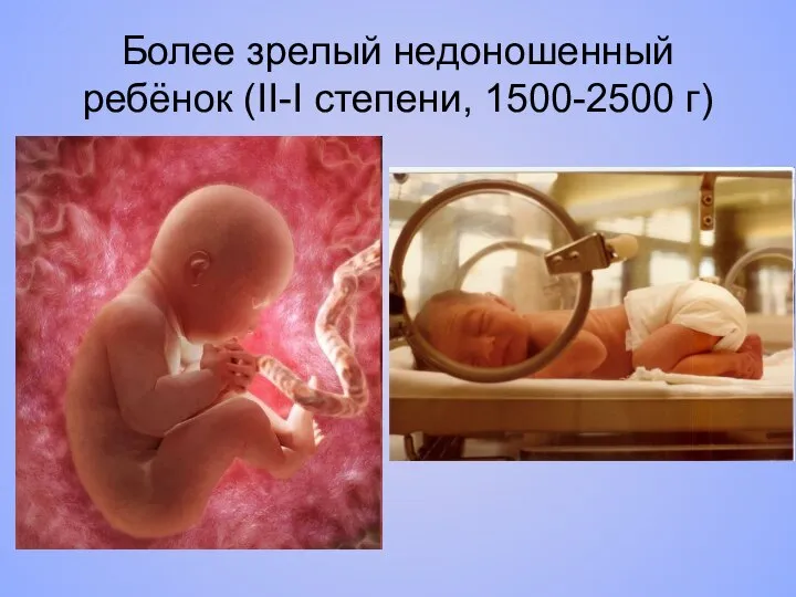 Более зрелый недоношенный ребёнок (II-I степени, 1500-2500 г)