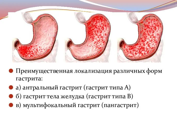 Преимущественная локализация различных форм гастрита: а) антральный гастрит (гастрит типа А) б)