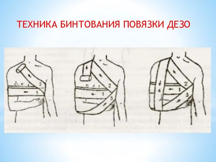 ТЕХНИКА БИНТОВАНИЯ ПОВЯЗКИ ДЕЗО