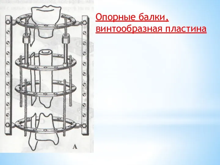 Опорные балки, винтообразная пластина