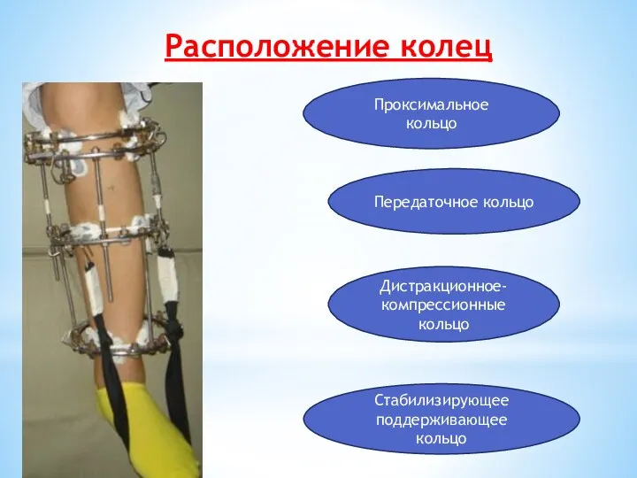 Расположение колец Проксимальное кольцо Дистракционное-компрессионные кольцо Стабилизирующее поддерживающее кольцо Передаточное кольцо