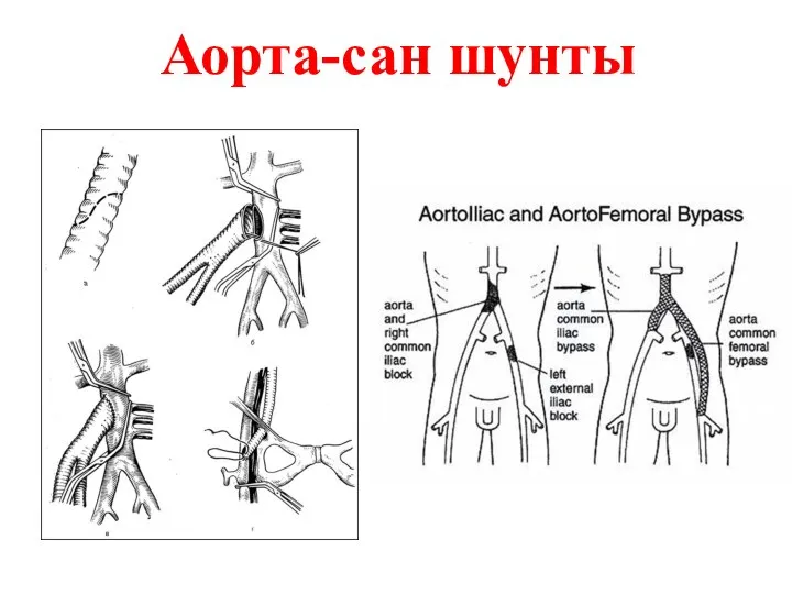 Аорта-сан шунты