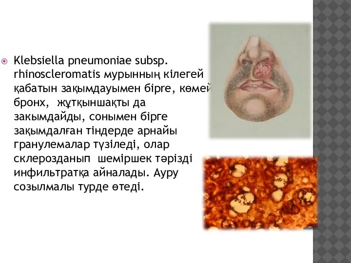 Klebsiella pneumoniae subsp. rhinoscleromatis мурынның кілегей қабатын зақымдауымен бipre, көмей, бронх, жұтқыншақты