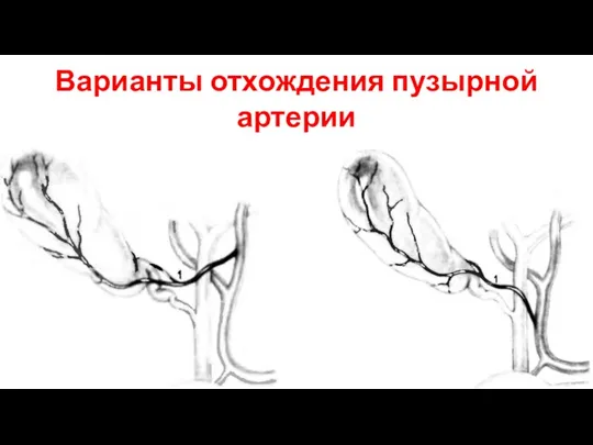 Варианты отхождения пузырной артерии