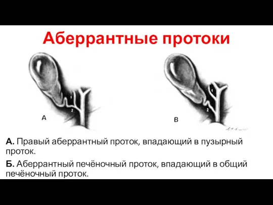 Аберрантные протоки А. Правый аберрантный проток, впадающий в пузырный проток. Б. Аберрантный