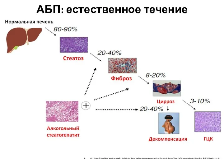 АБП: естественное течение Eric S Orman, Gemma Odena and Ramon Bataller. Alcoholic