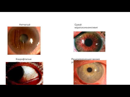 Нитчатый кератит Сухой кератоконъюнктивит Рецидивирующая эрозия роговицы Ксерофтальмия