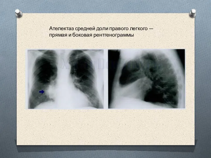 Ателектаз средней доли правого легкого — прямая и боковая рентгенограммы