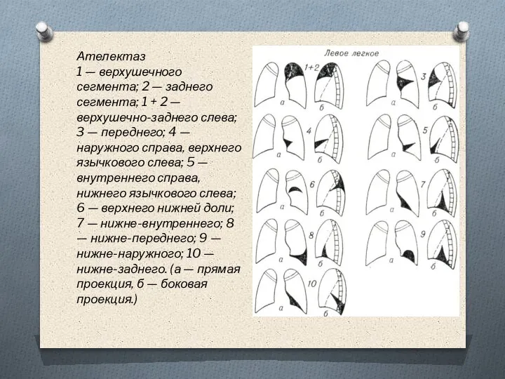 Ателектаз 1 — верхушечного сегмента; 2 — заднего сегмента; 1 + 2