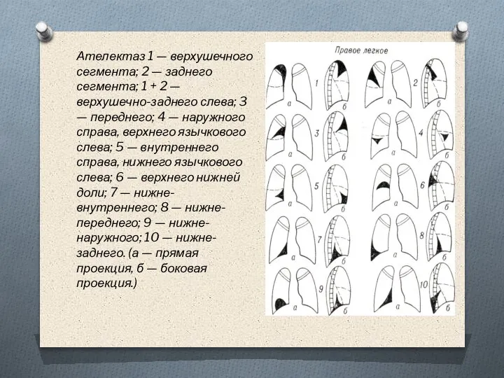 Ателектаз 1 — верхушечного сегмента; 2 — заднего сегмента; 1 + 2