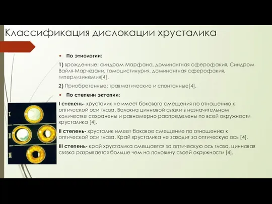 Классификация дислокации хрусталика По этиологии: 1) врожденные: синдром Марфана, доминантная сферофакия, Синдром