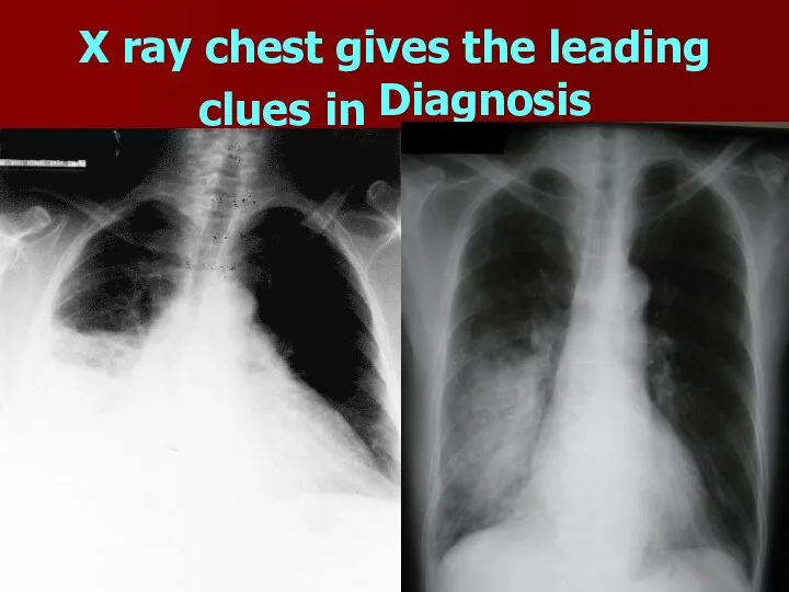 X ray chest gives the leading clues in Diagnosis
