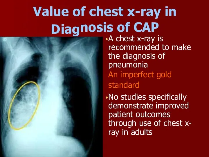 Value of chest x-ray in Diag nosis of CAP A chest x-ray