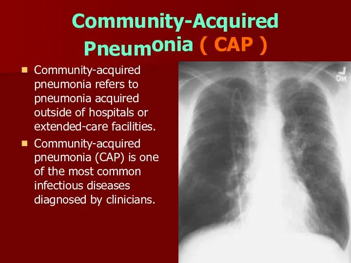 Community-Acquired Pneum onia ( CAP ) ■ Community-acquired ■ pneumonia refers to